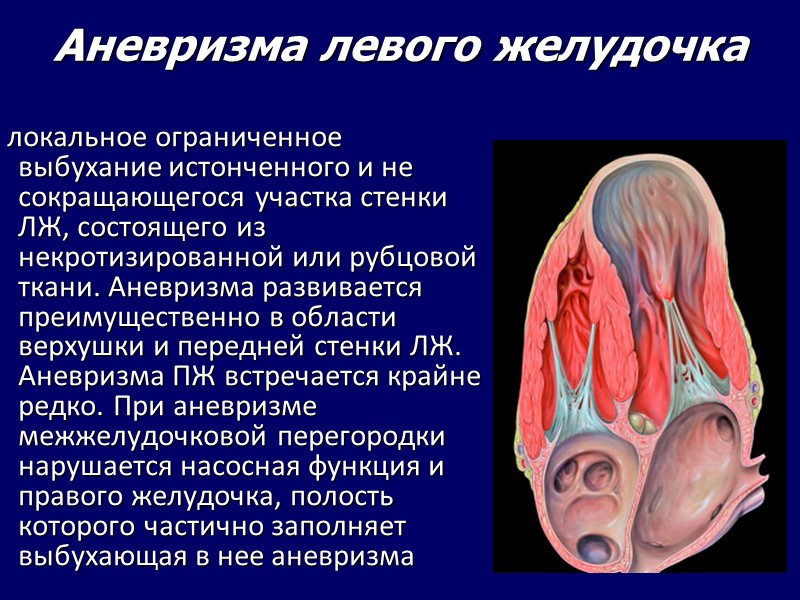 Аневризма левого желудочка локальное ограниченное выбухание истонченного и не сокращающегося Аневризма левого желудочка локальное ограниченное выбухание истонченного и не сокращающегося